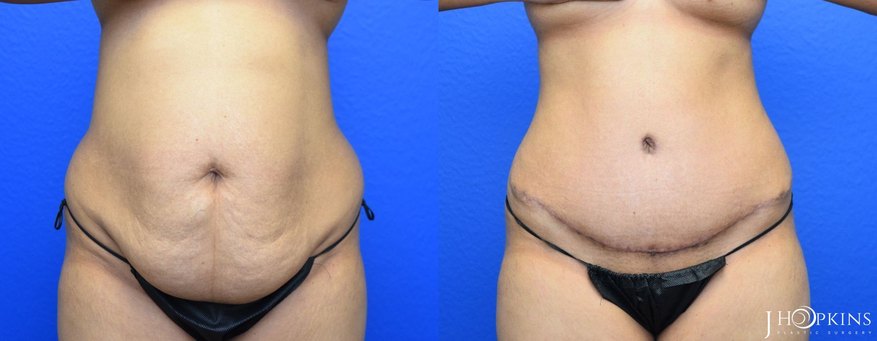 Tummy Tuck - Case 10505