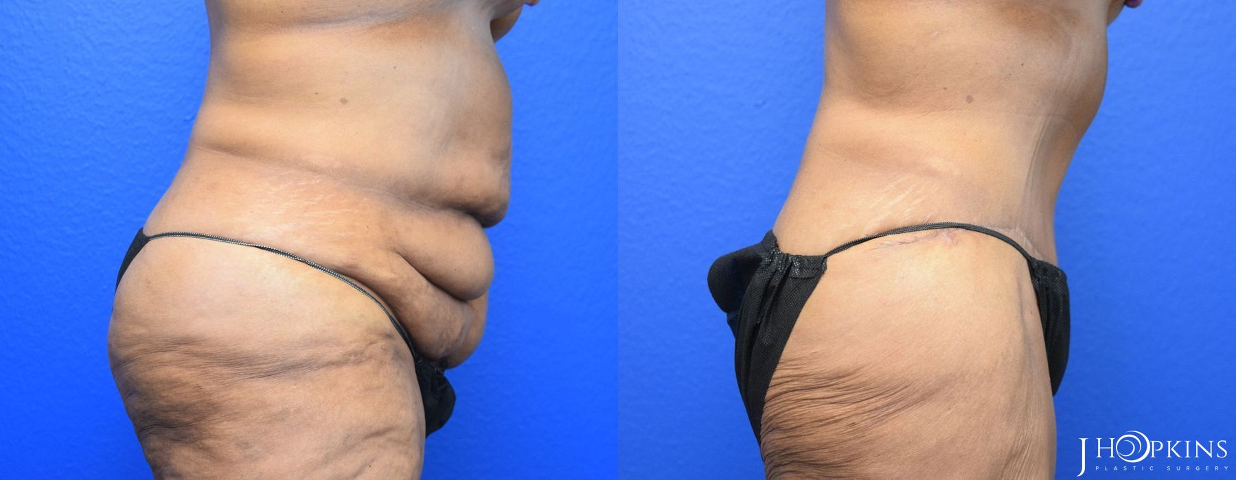 Tummy Tuck - Thumbnail 3