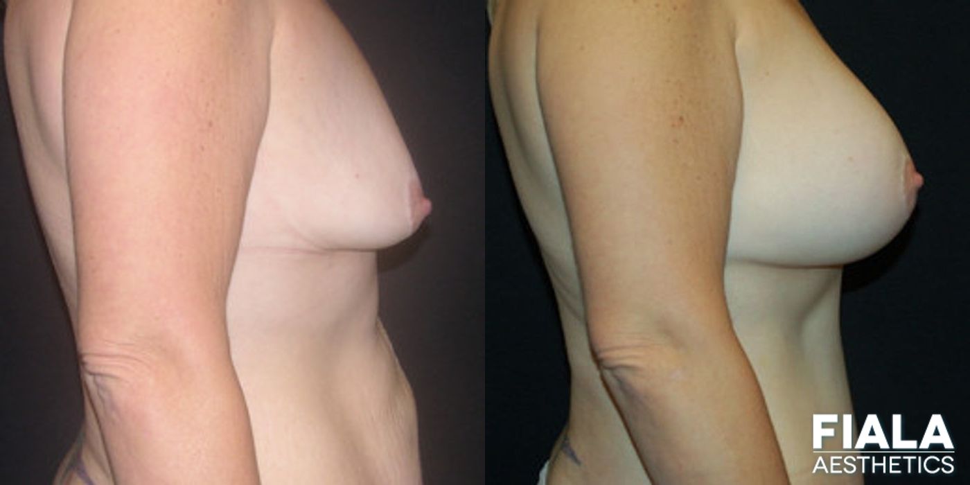 200cc breast implant before after Orlando - Angle 2