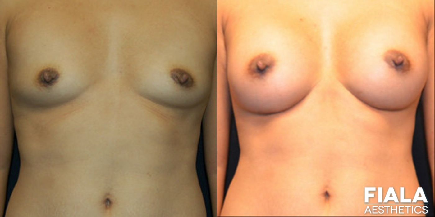 200cc Implants - Case 9102