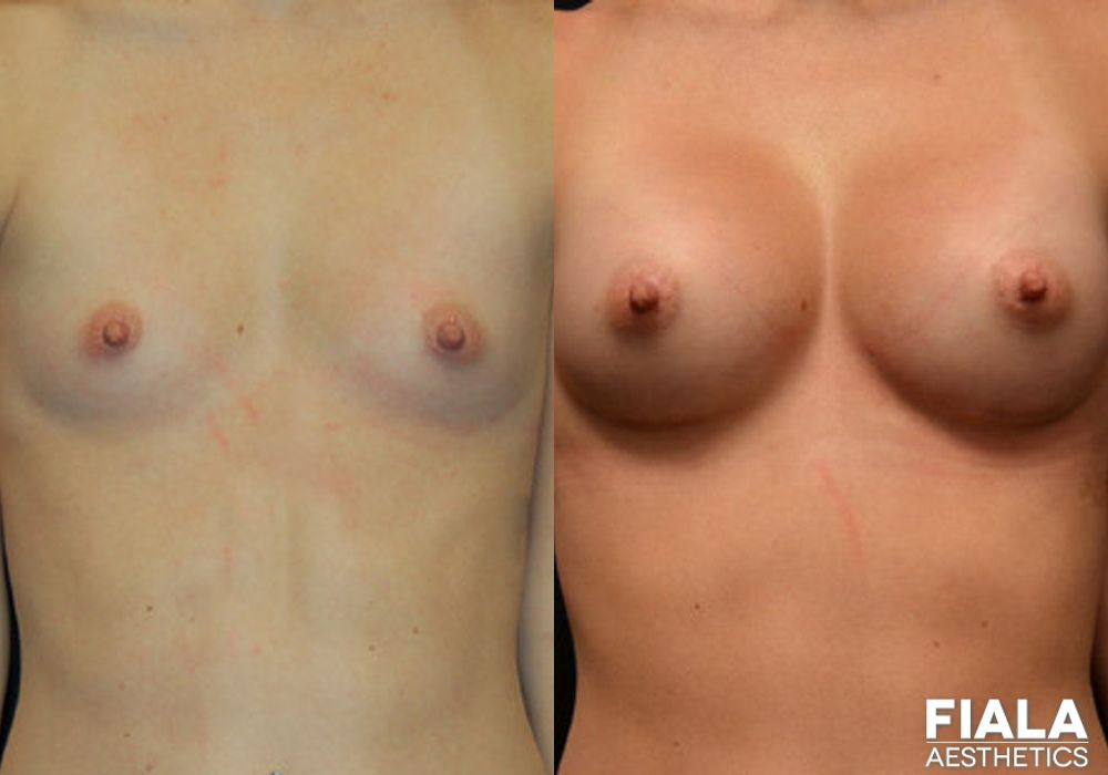 200cc Implants - Case 8884