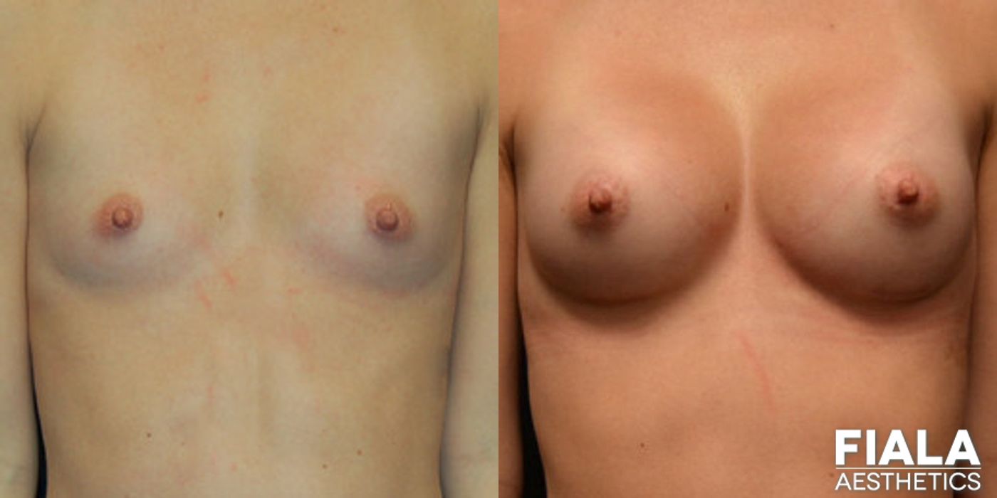 200cc Implants - Case 9100