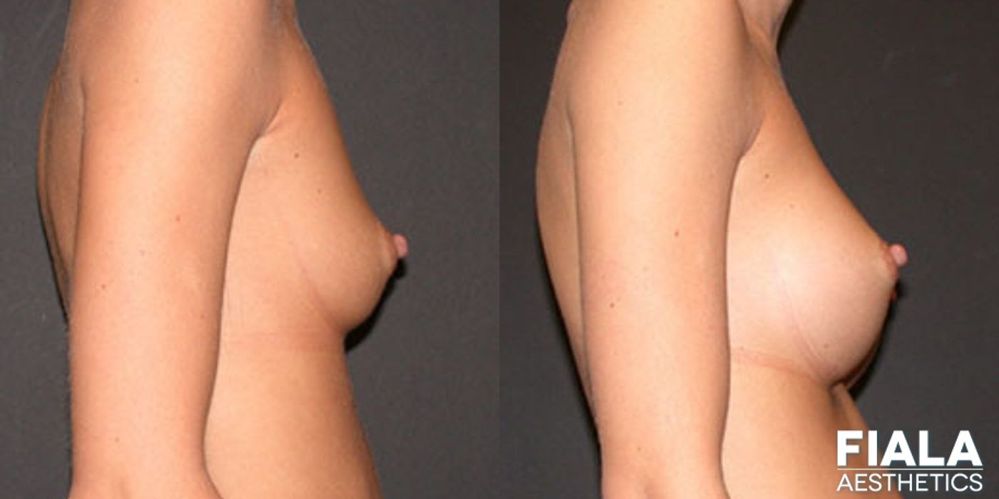 200cc Implants - Thumbnail 2