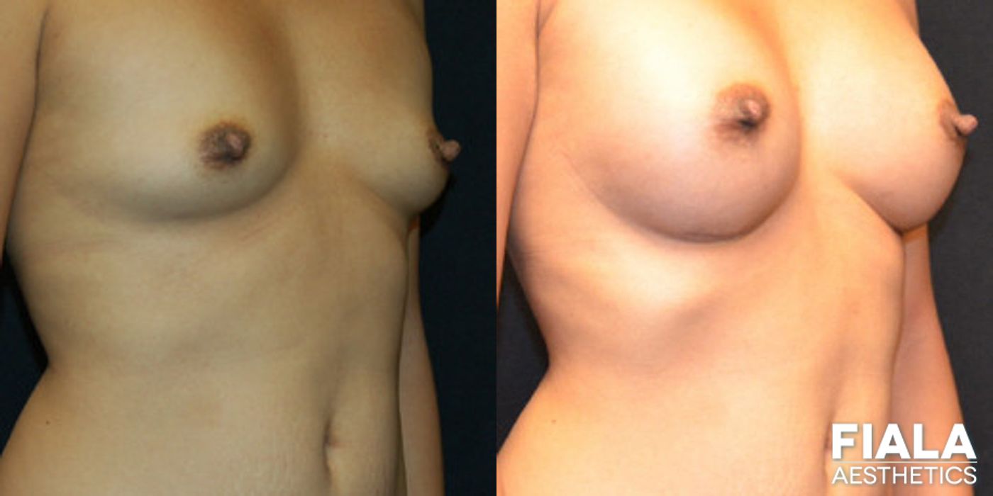 Before and after 200cc Implants case 13671 - Angle 2