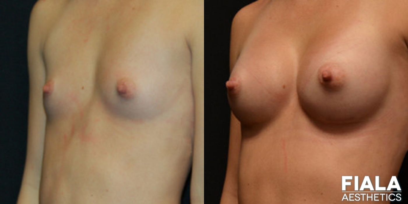 200cc Implants - Thumbnail 2