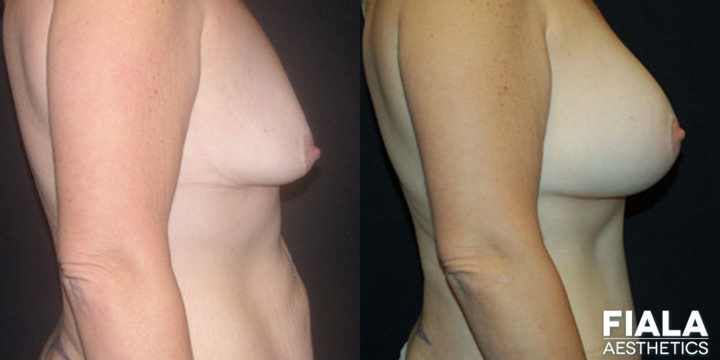 200cc Implants - Thumbnail 2