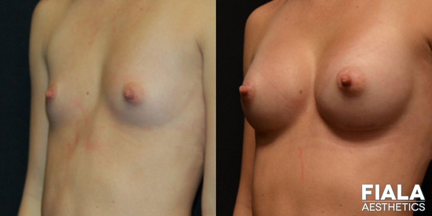 Before and after 200cc Implants case 13667 - Angle 2