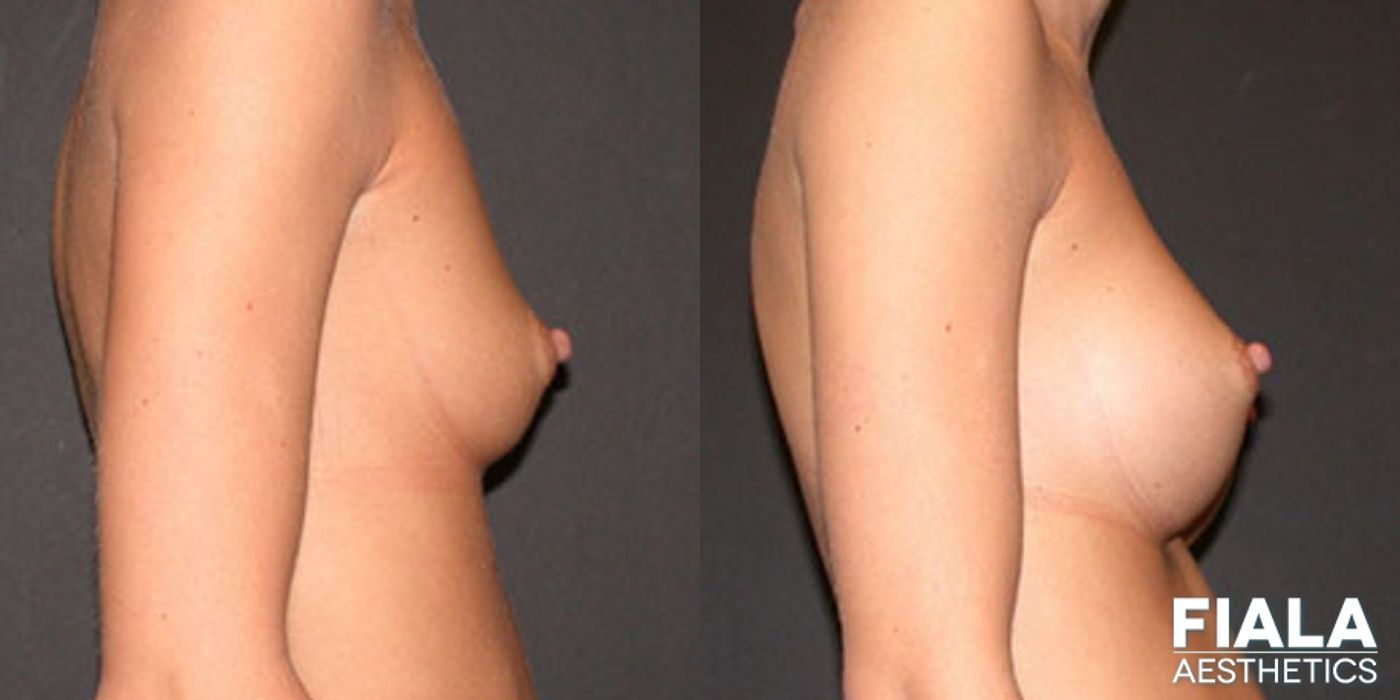 Before and after 200cc Implants case 13662 - Angle 2