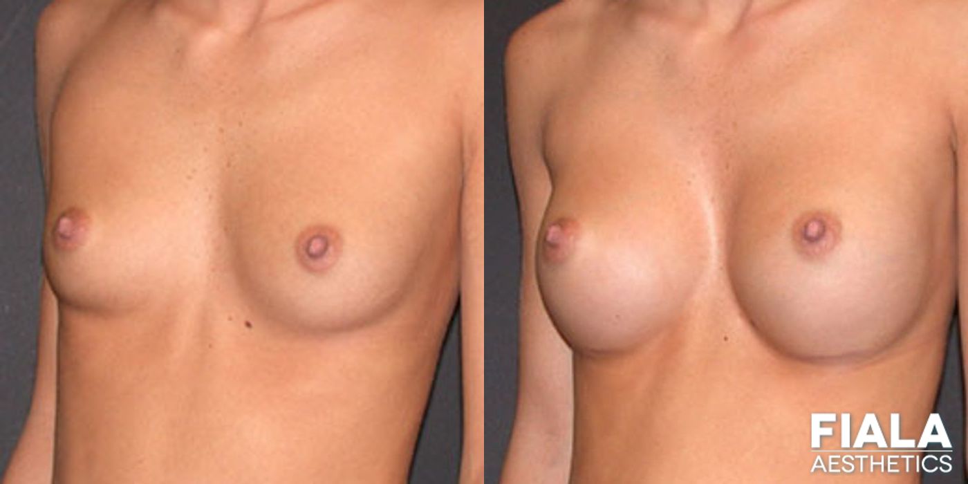 Before and after 200cc Implants case 13662