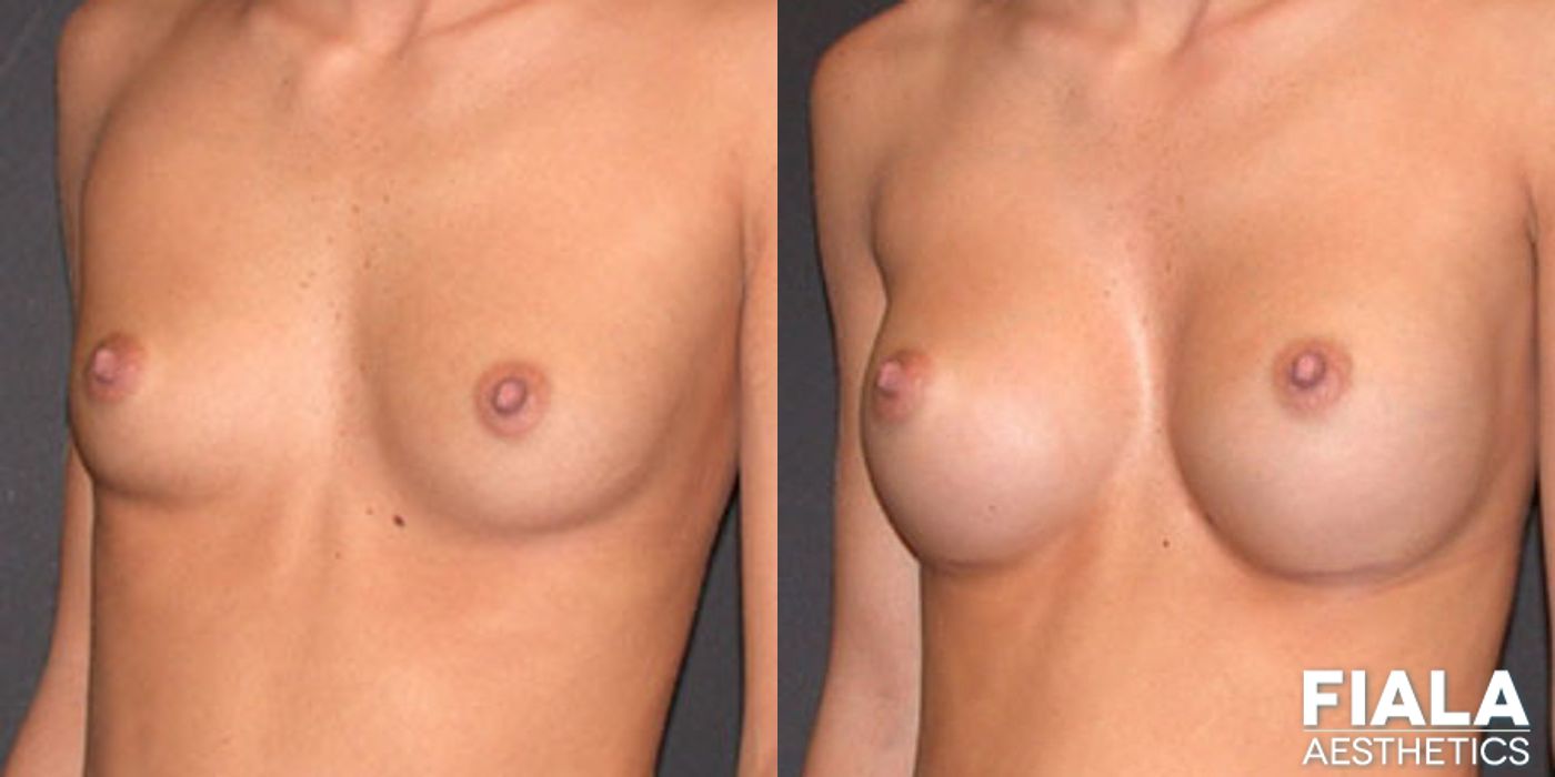 200cc Implants - Case 9101