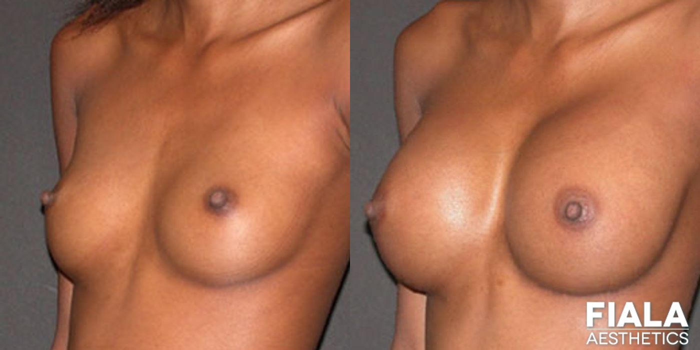 300cc Implants - Case 9111