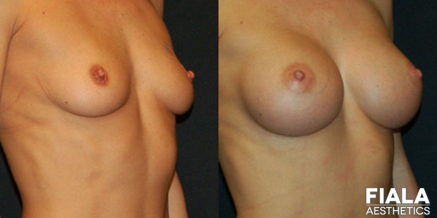 300cc Implants - Thumbnail 2