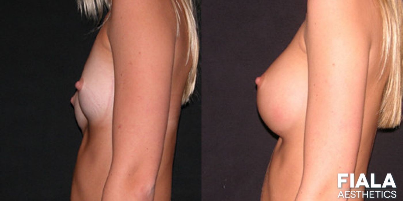 300cc Implants - Thumbnail 2