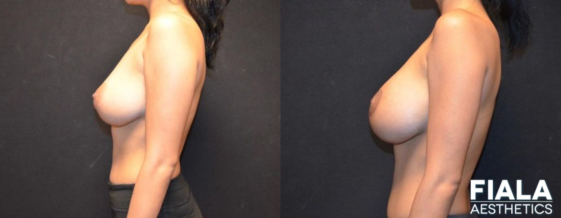 300cc Implants - Thumbnail 2