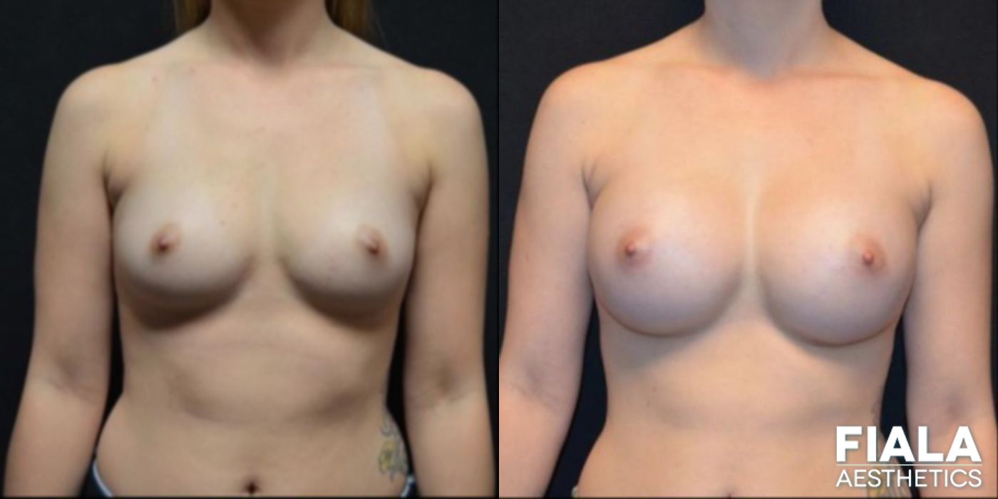 Before and after 300cc Implants case 13673