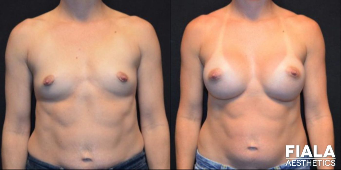 Before and after 300cc Implants case 13674