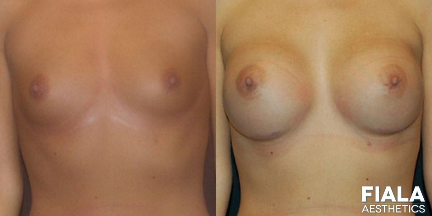 300cc Implants - Thumbnail 2