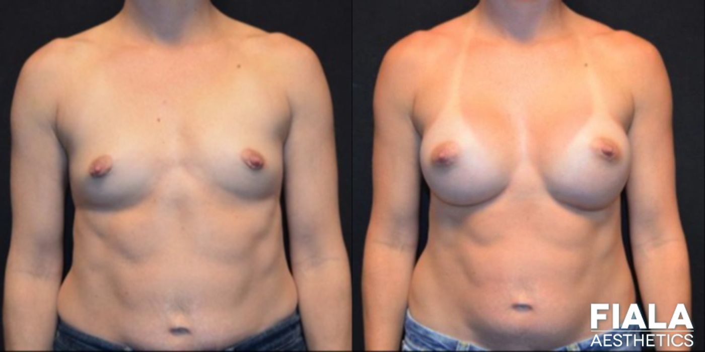 300cc Implants - Case 9105