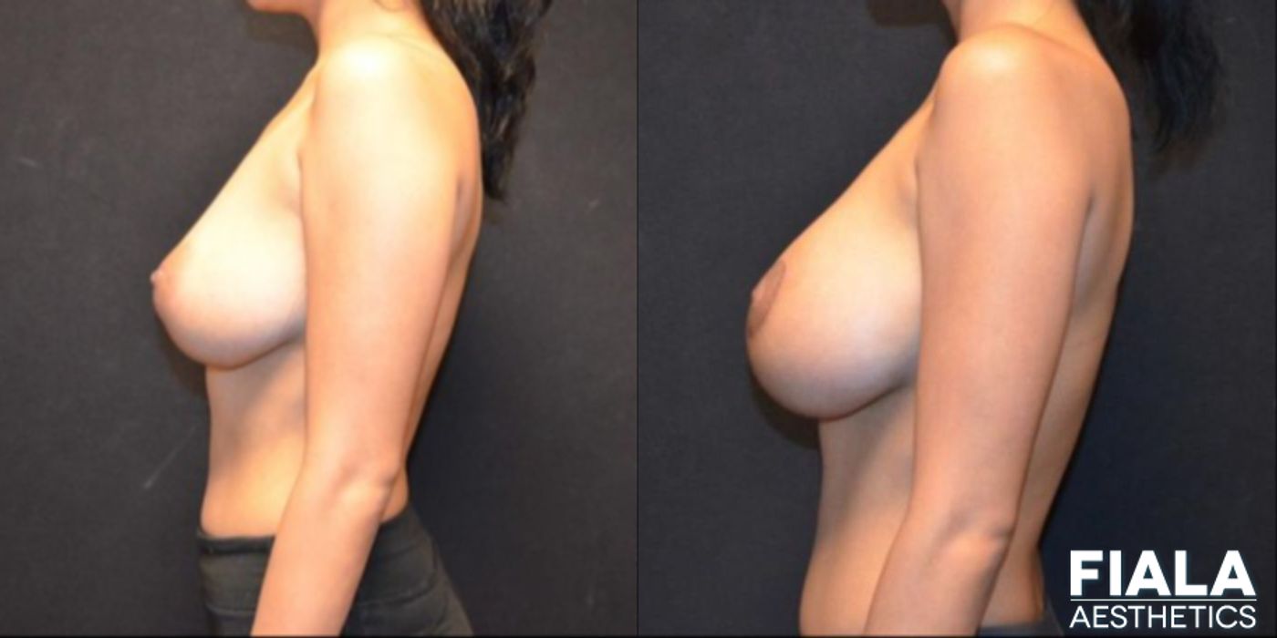 300cc Implants - Thumbnail 2