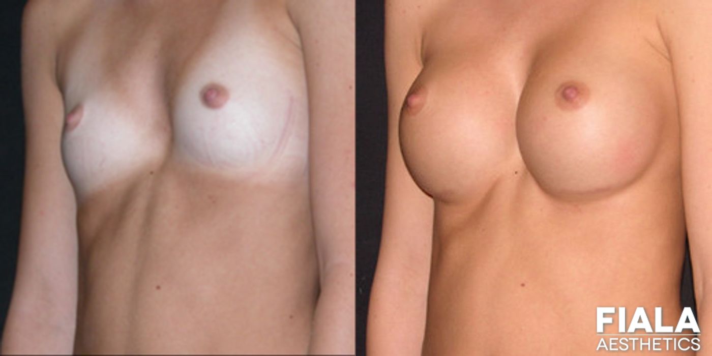 300cc Implants - Case 9128