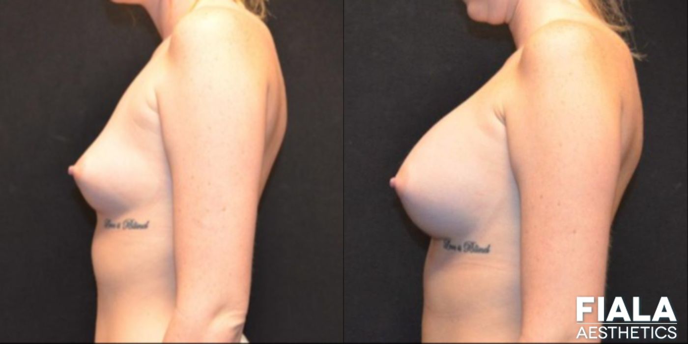 300cc Implants - Thumbnail 2