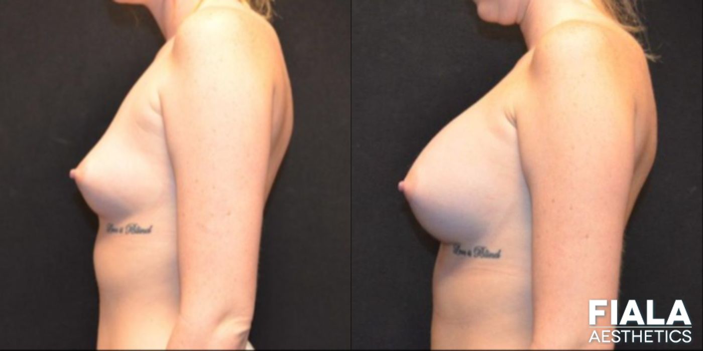 Before and after 300cc Implants case 13675 - Angle 2