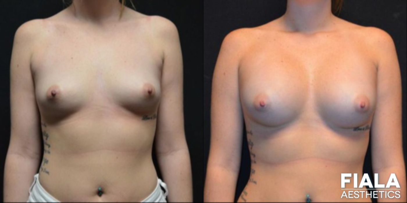 Before and after 300cc Implants case 13675