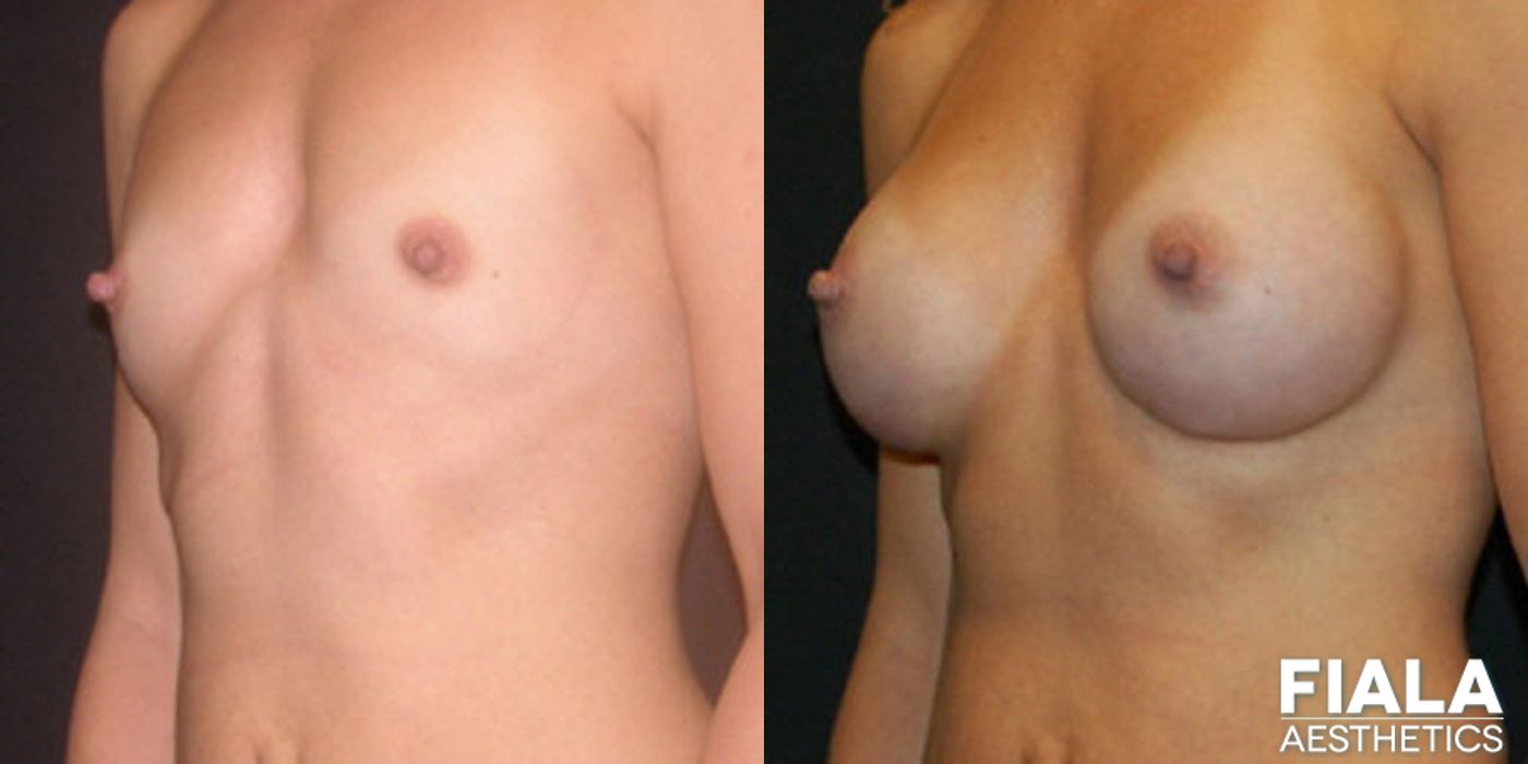 300cc Implants - Thumbnail 2