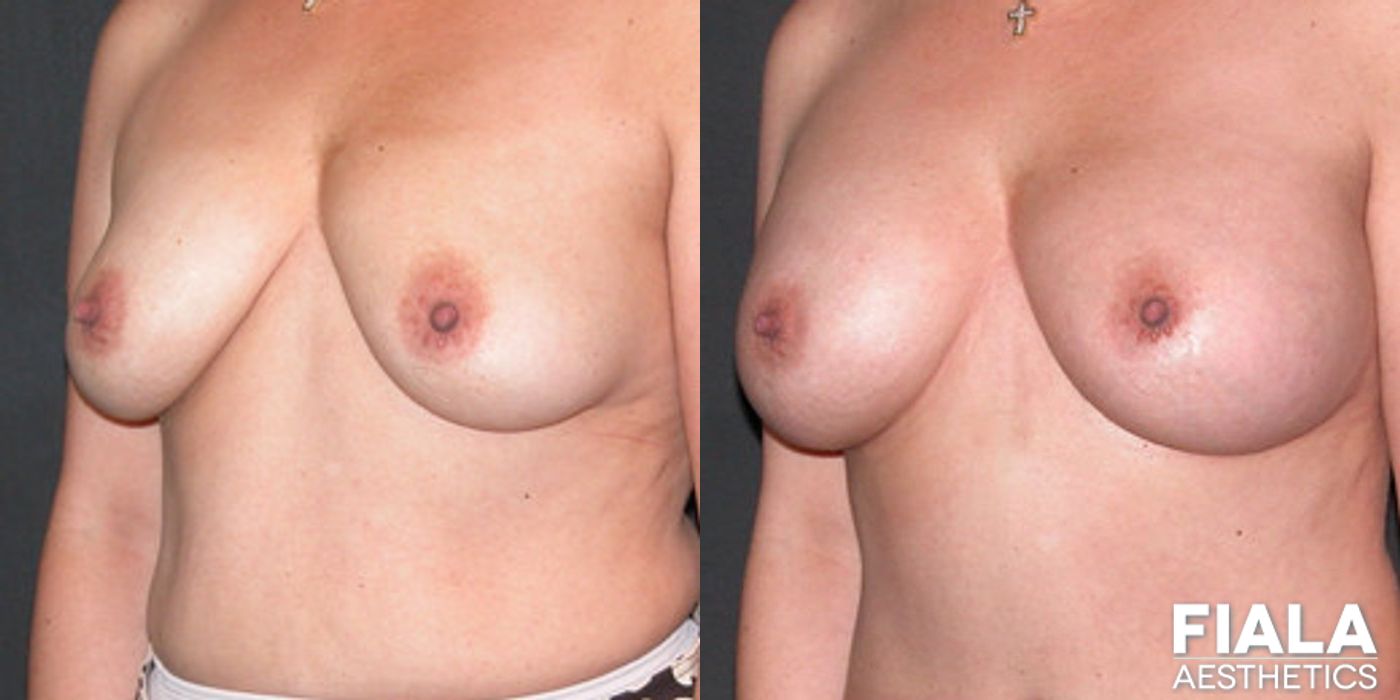 300cc Implants - Thumbnail 2