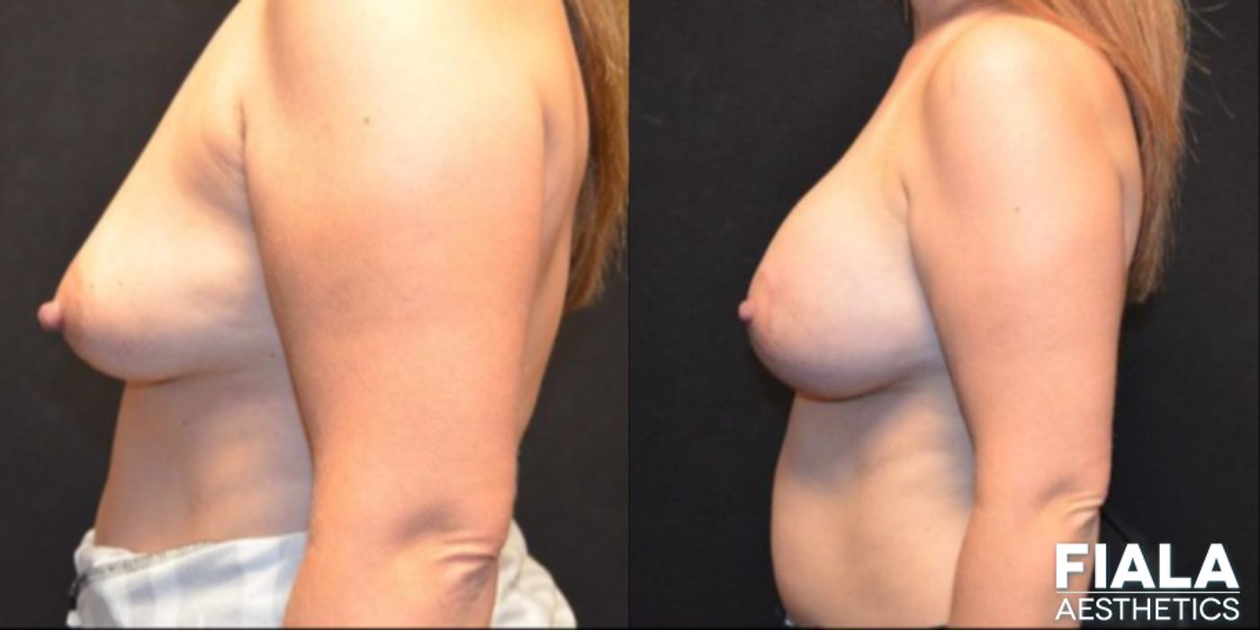 300cc Implants - Thumbnail 2