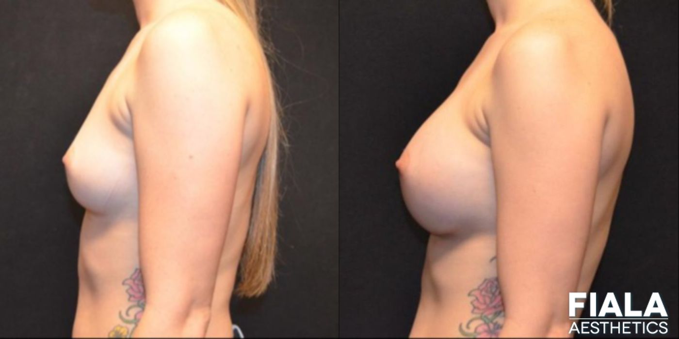 300cc Implants - Case 9104