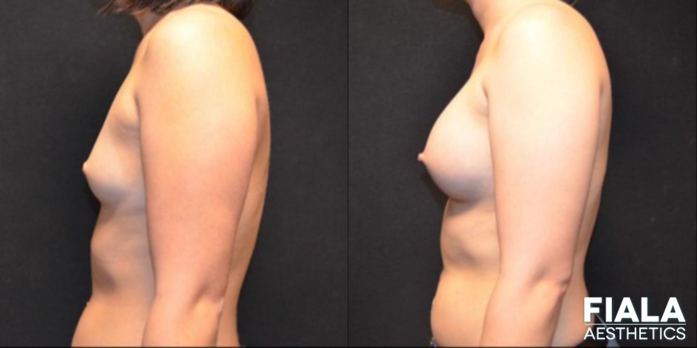 Before and after 300cc Implants case 13676 - Angle 2