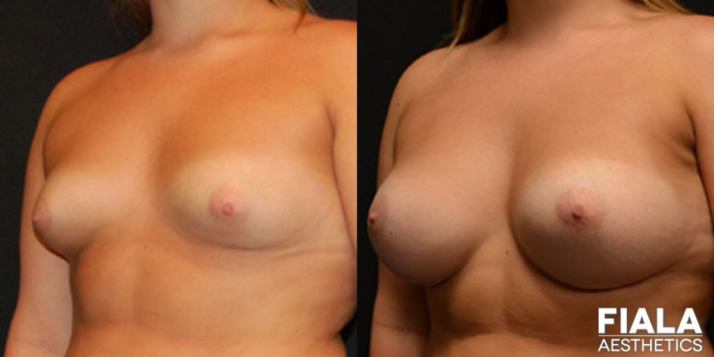 300cc Implants - Thumbnail 2