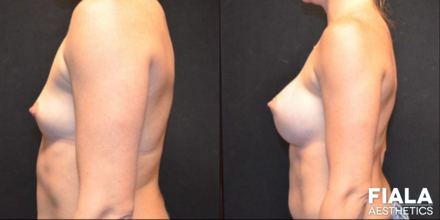 Before and after 300cc Implants case 13674 - Angle 2