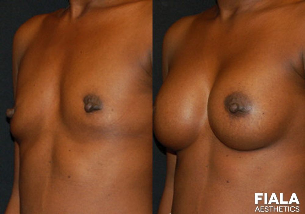 300cc Implants - Thumbnail 2