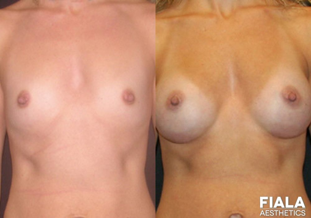 300cc Implants - Case 8903