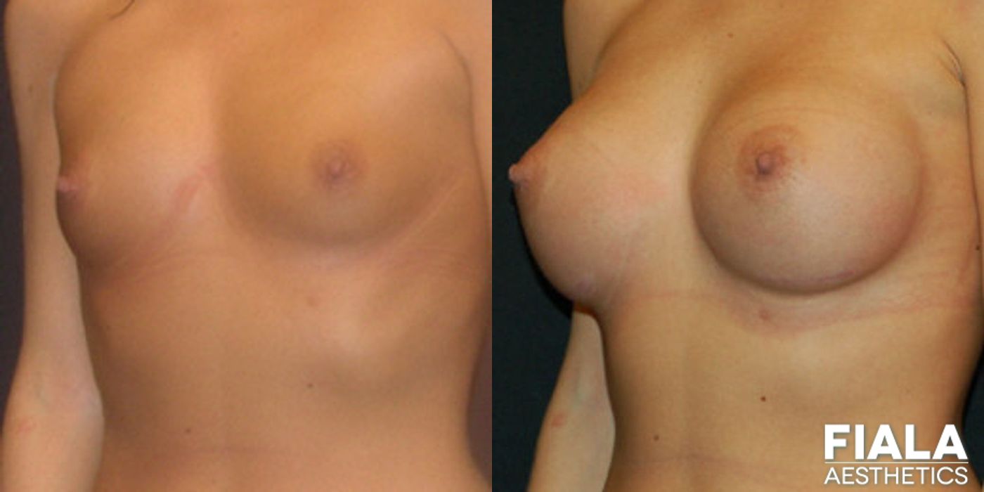 300cc Implants - Case 9124