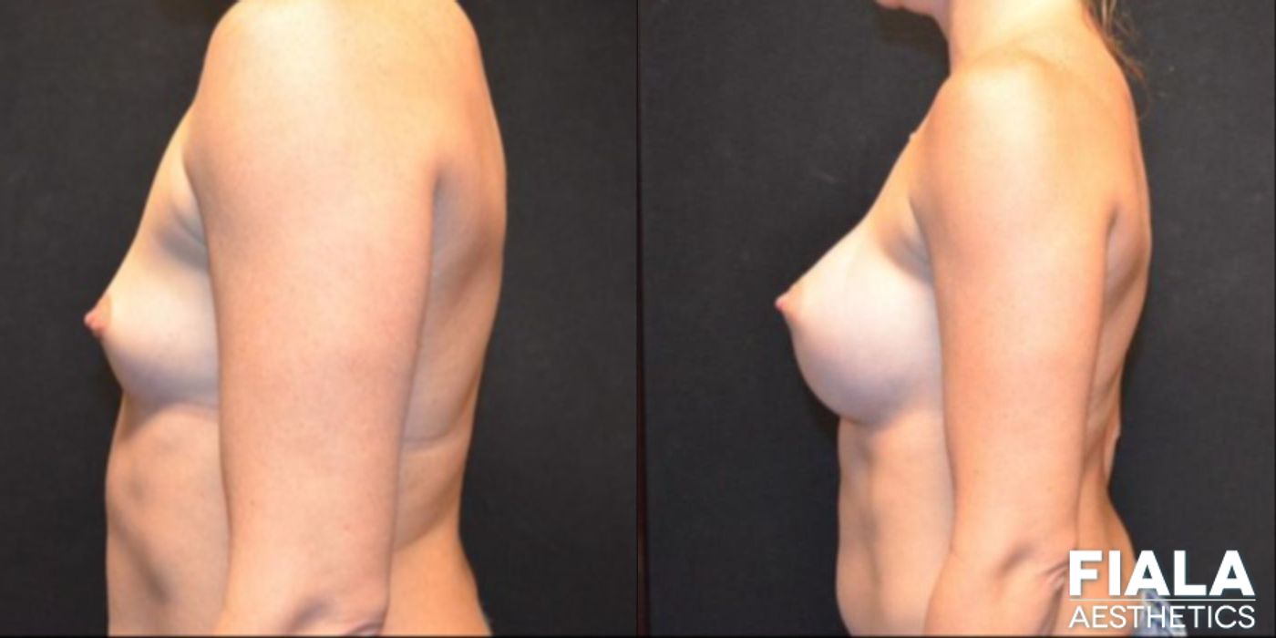 300cc Implants - Thumbnail 2