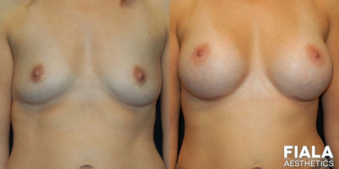 300cc Implants - Case 9119