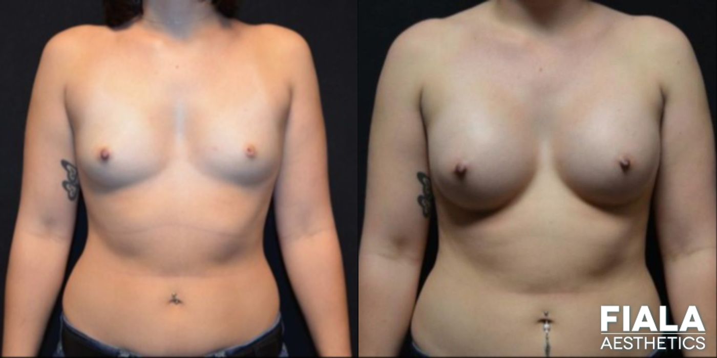 Before and after 300cc Implants case 13676