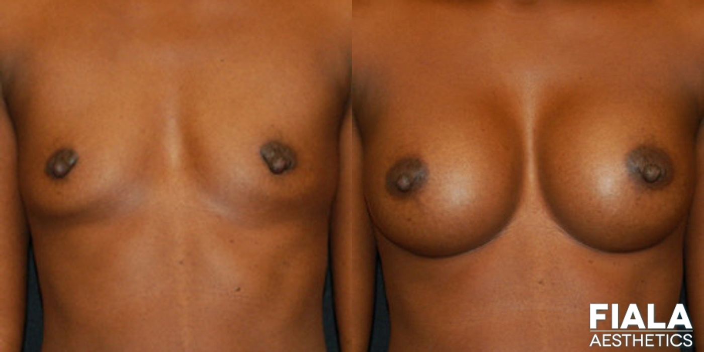 300cc Implants - Case 9116