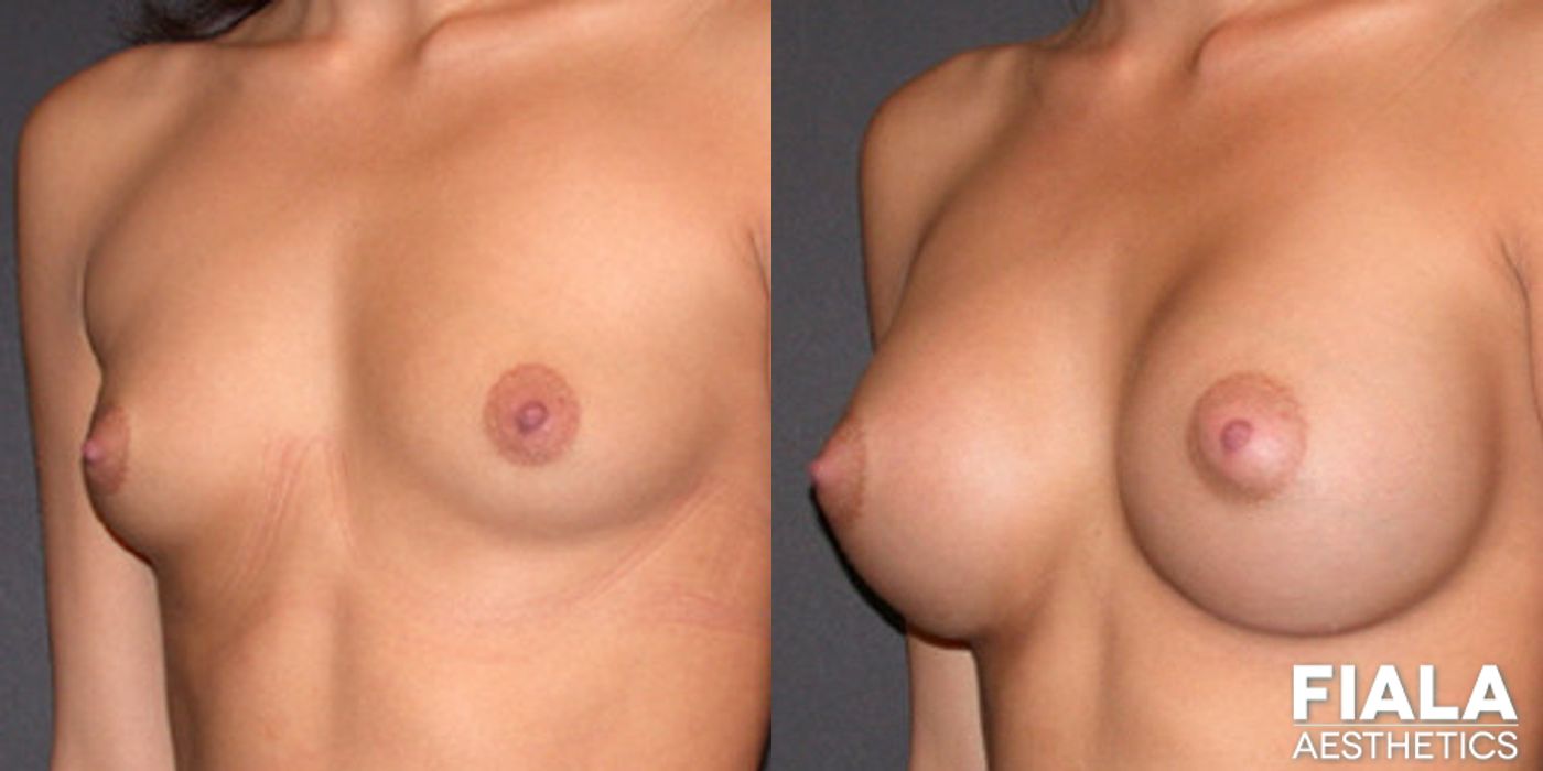 300cc Implants - Thumbnail 2