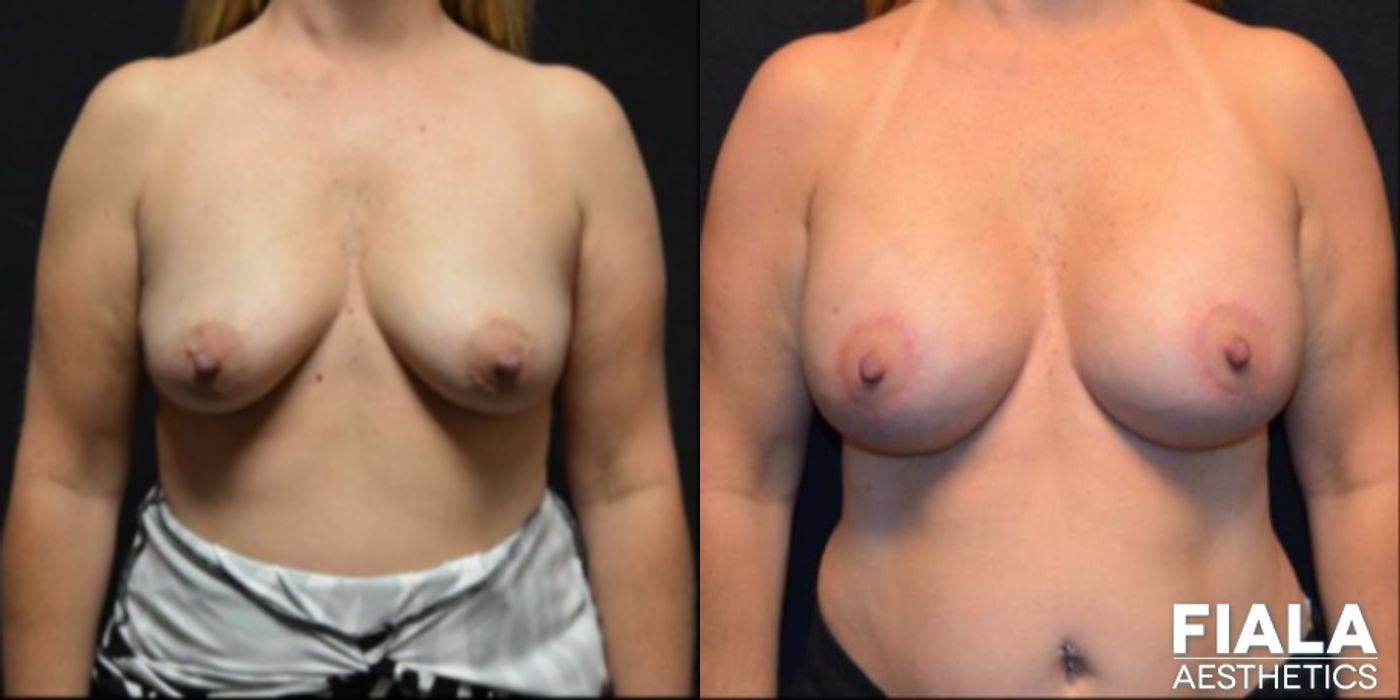 300cc Implants - Case 9108