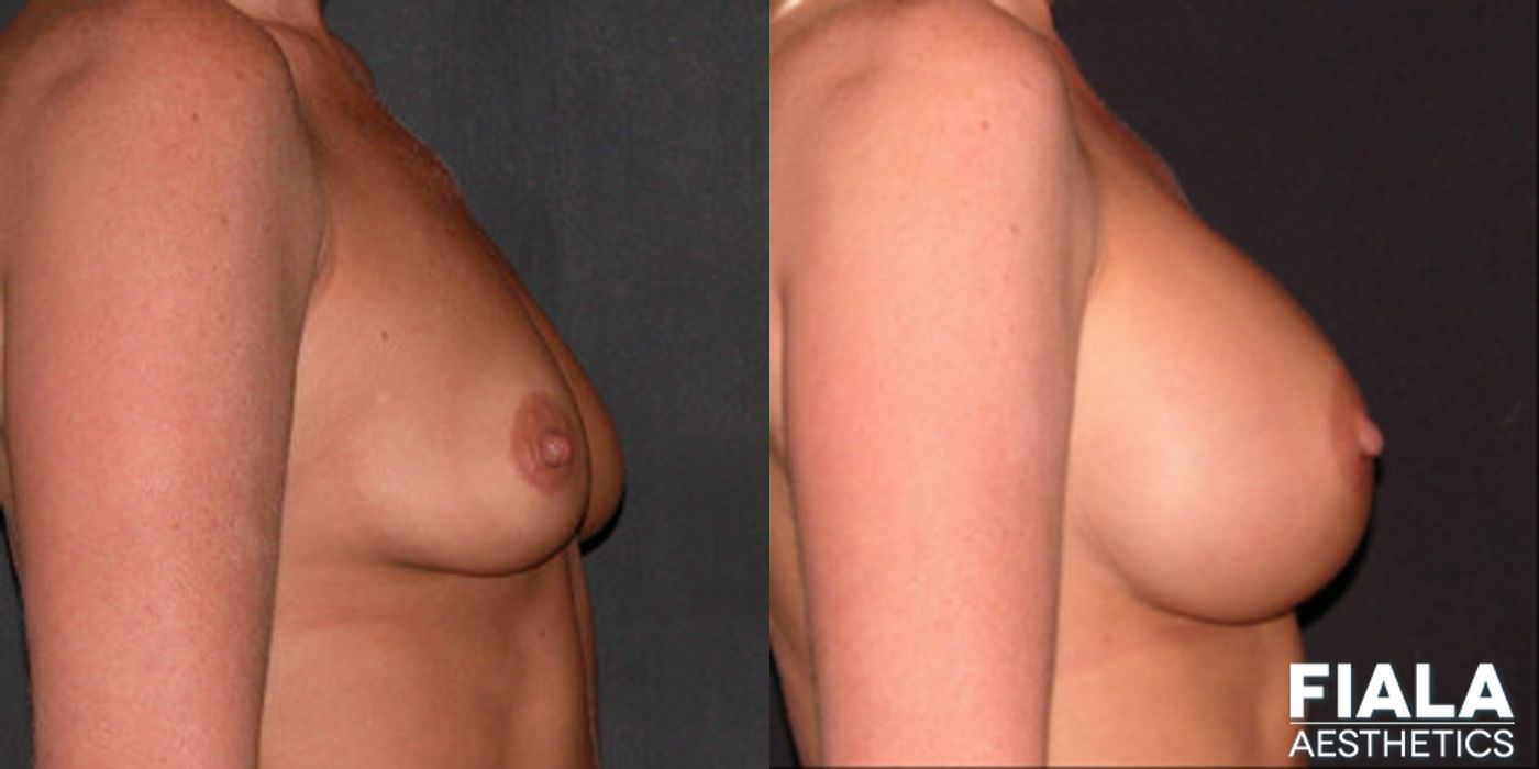 300cc Implants - Thumbnail 2