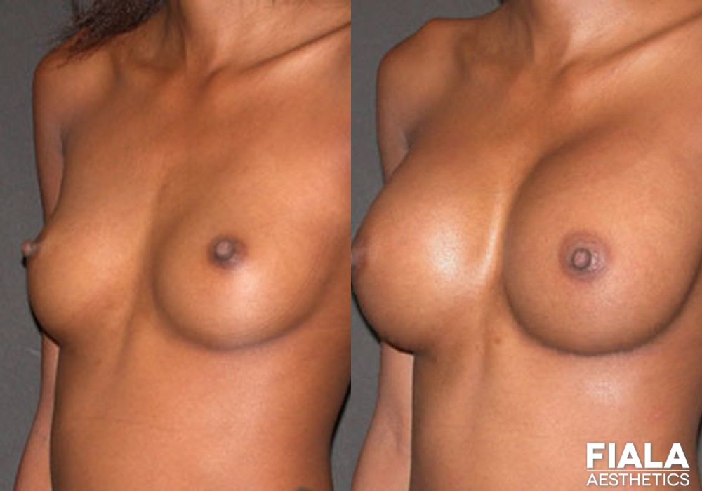 300cc Implants - Thumbnail 2