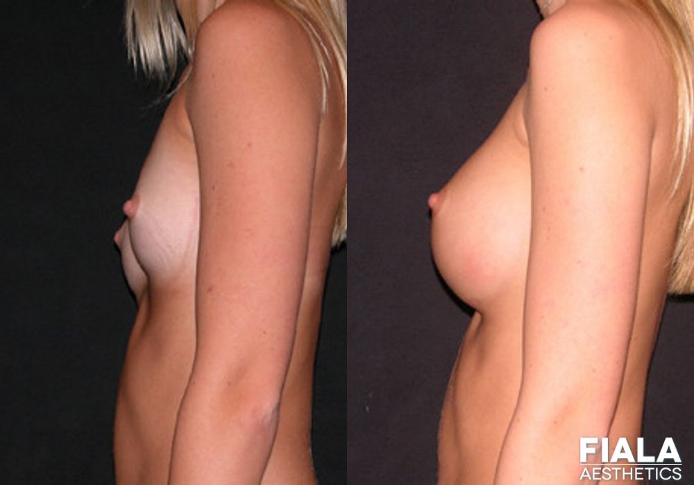 300cc Implants - Thumbnail 2