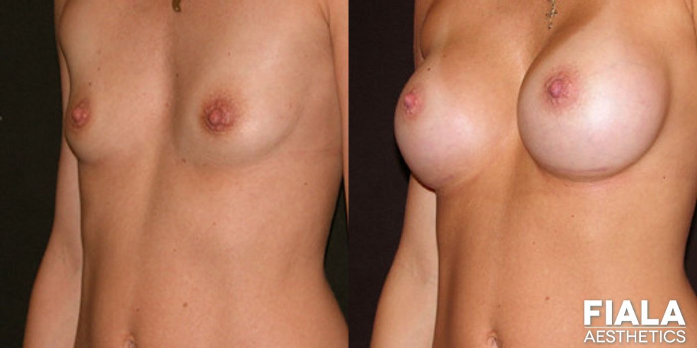 300cc Implants - Thumbnail 2