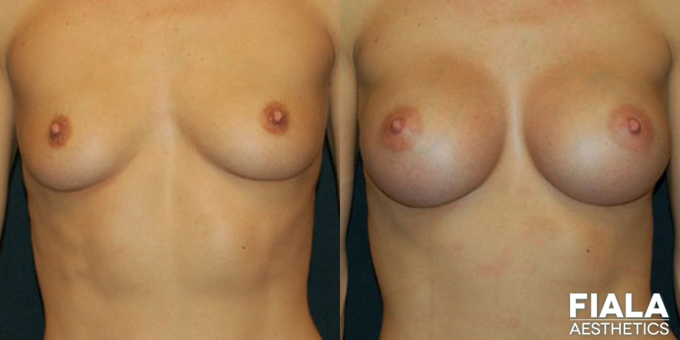 300cc Implants - Case 9123