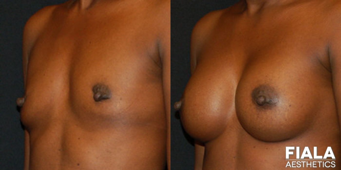 300cc Implants - Thumbnail 2