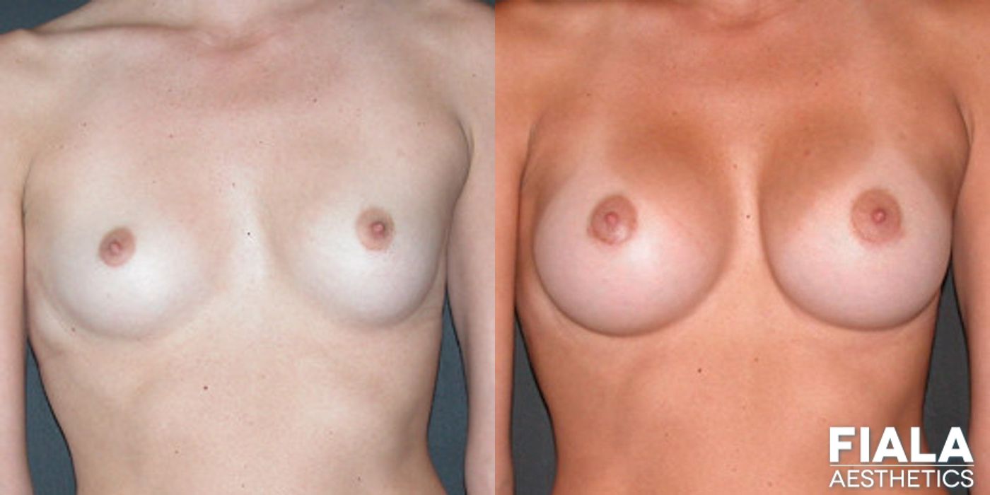 300cc Implants - Case 9114